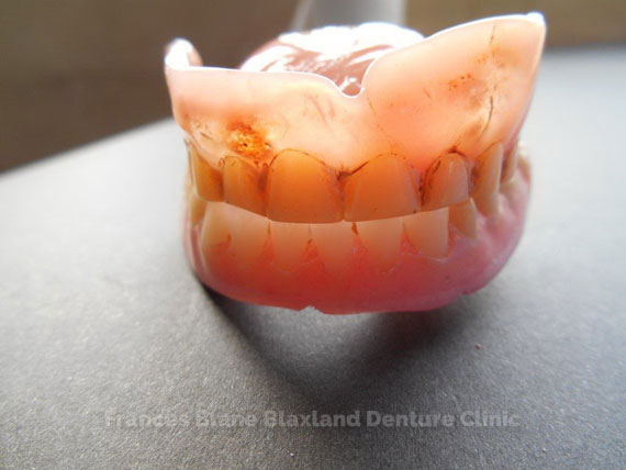 Broken down worn out complete dentures that need replacing